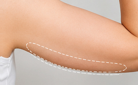 을지로 팔뚝 온다리프팅, 팔 라인이 처져 보이는 까닭은?