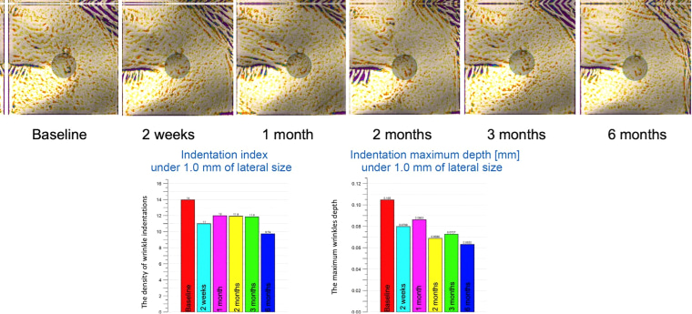 명동스킨부스터, 효과는 얼마나 이어질까요?
